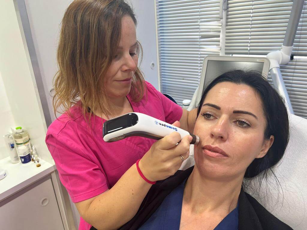 Tratamiento estético Dermapen es uno de los servicios de clinica ocean de Marbella