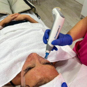 Aesthetic PRP treatment with Dermapen to improve the appearance of the skin at Clinica Ocean in Marbella