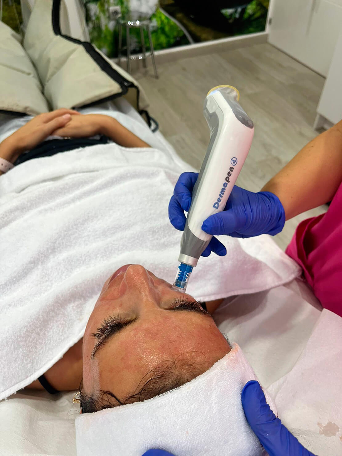Aesthetic PRP treatment with Dermapen to improve the appearance of the skin at Clinica Ocean in Marbella